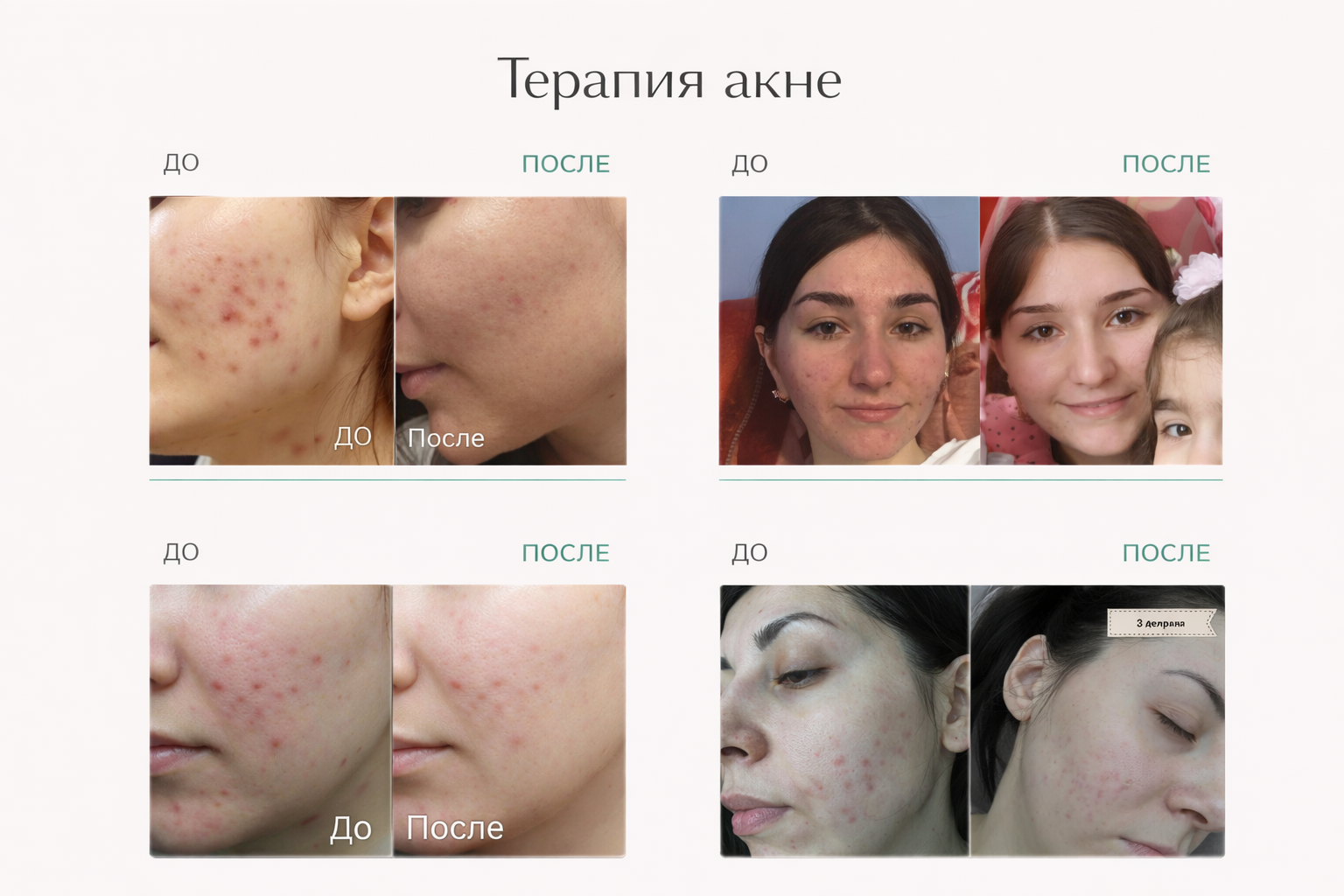 Терапия акне